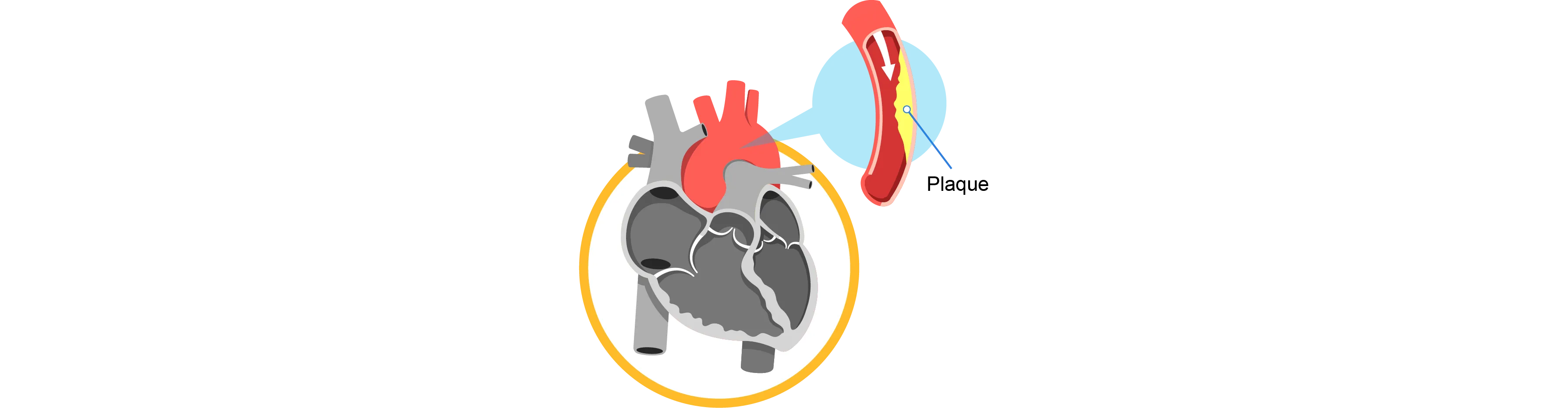 coronary_artery_disease_banner_185729d3a-adc2-4d54-ab36-15afb460a17b