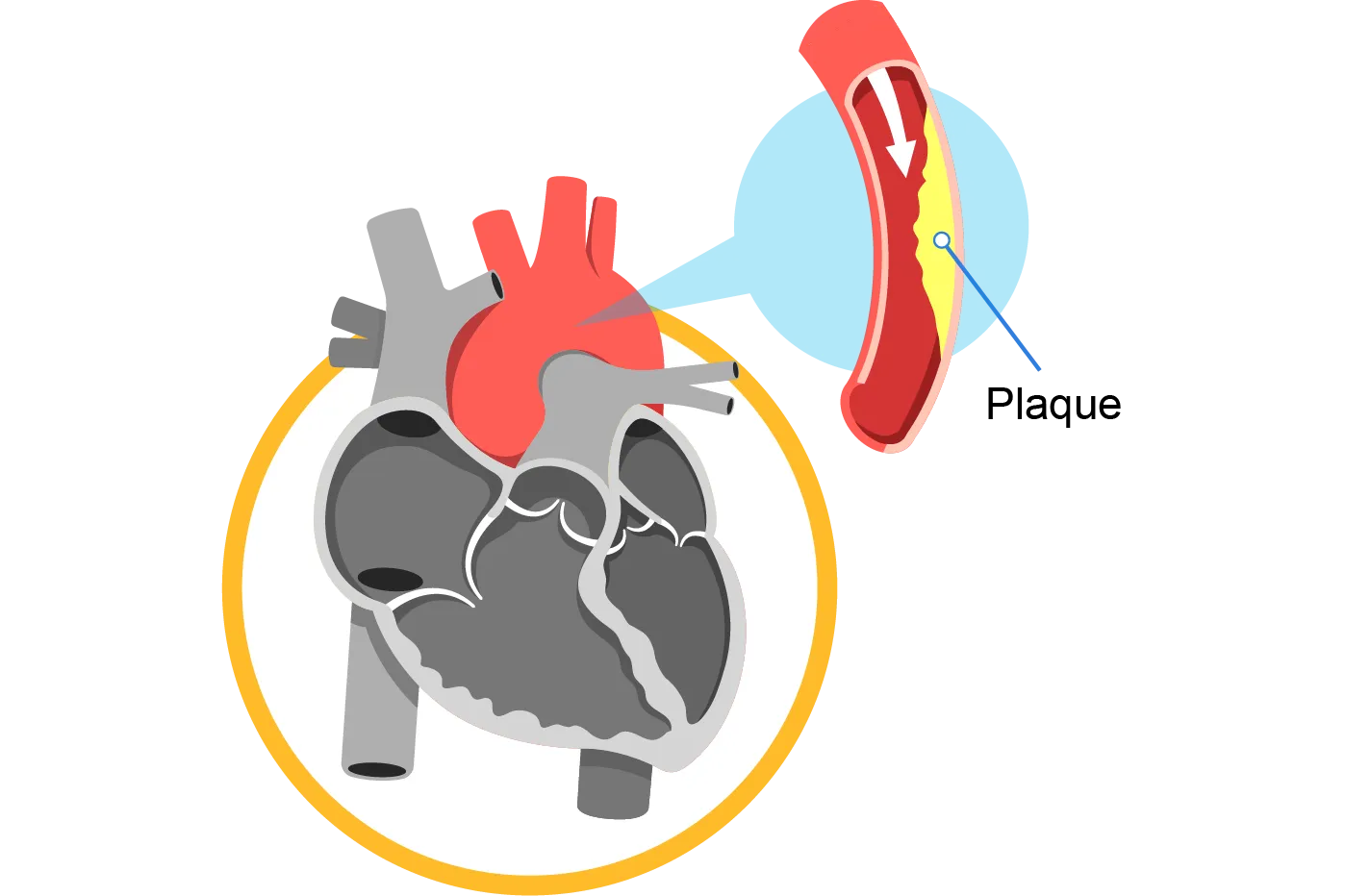 coronary_artery_disease_banner_mobile